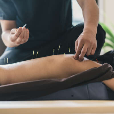 Trigger Points, Dry Needling,Therapist,Giving,Acupuncture,Treatment,To,A,Japanese,Woman