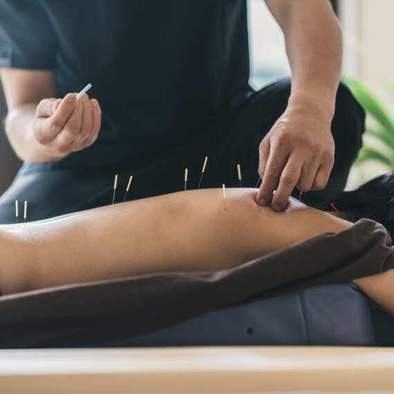 Trigger Points, Dry Needling,Therapist,Giving,Acupuncture,Treatment,To,A,Japanese,Woman